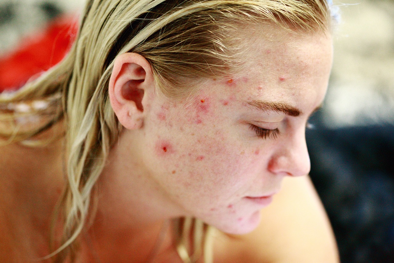 skin acne and rash